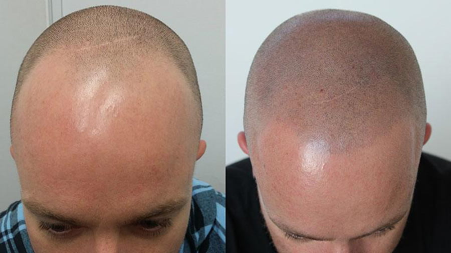 scalp-micropigmentation-creative-hair-clinic-leixlip