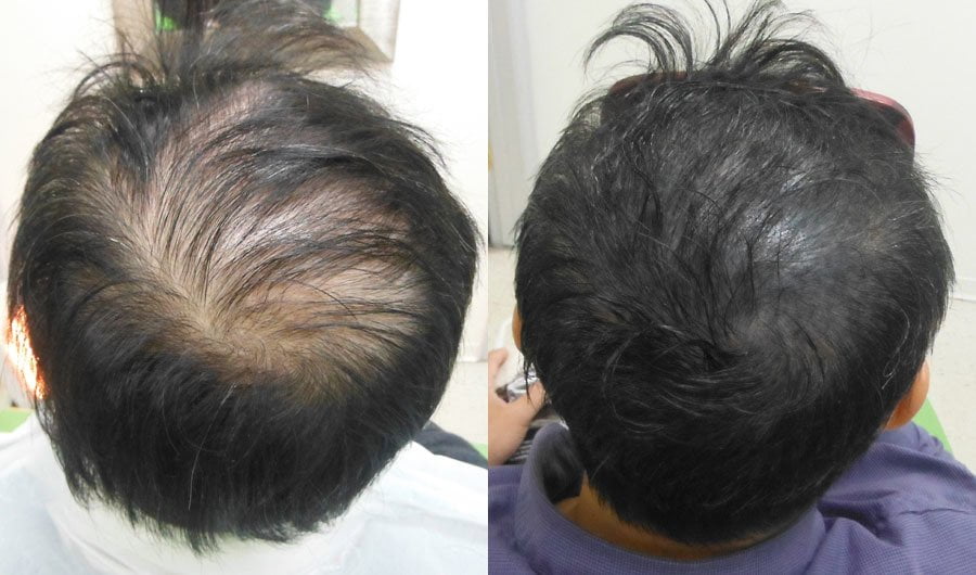 Micropigmentation du cuir chevelu pour les cheveux clairsemés